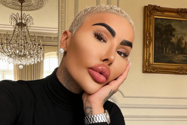 &laquo;Король губ&raquo; скончался после неудачной бьюти-процедуры